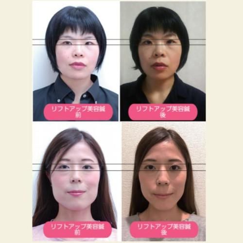 リフトアップ初回お試し美容鍼コース40分 輸入バレエレオタード シューズ 巻きスカートならラベルフェ リフトアップ初回お試し美容鍼コース40分 輸入バレエレオタード シューズ 巻きスカートならラベルフェ