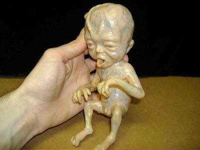 封入胎児 Fetus In Fetu Japaneseclass Jp
