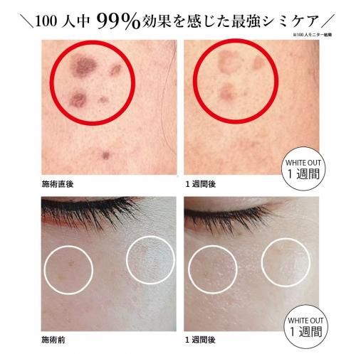 ザホワイトアウト(シミケアマシーン)専用美容液セット - 【公式